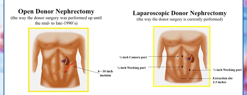 Laparoscopy Donor Nephrectomy Surgery Meerut