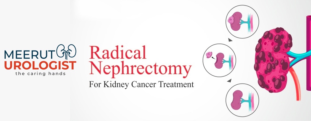 Laparoscopy Radical Nephrectomy Surgery Meerut