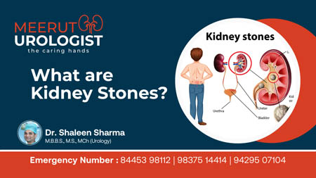 What are Kidney Stones - Dr Sarat Chandra Garg Video